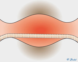 Was lässt Sie lächeln?Zahnseide oder Interdentalbürste? - Zahnseide putzt ins Leere